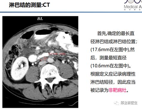 壹生资讯 实体瘤疗效评价标准全面解读！附实例！