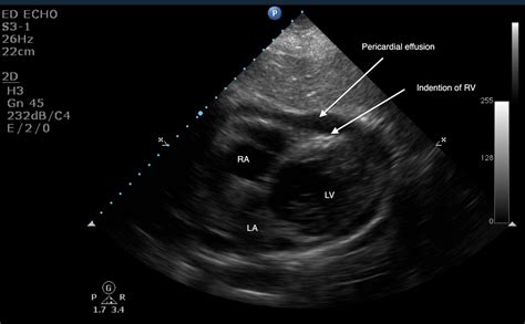 Pericardial Effusion Ultrasound