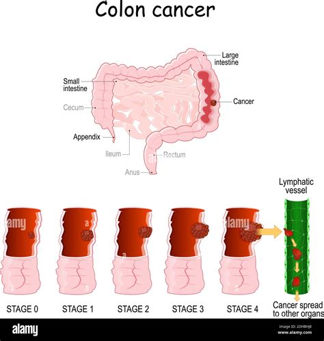 Colon Cancer Colorectal Oncology Development Of A Malignant Tumor From 0 To 4 Stages Medical