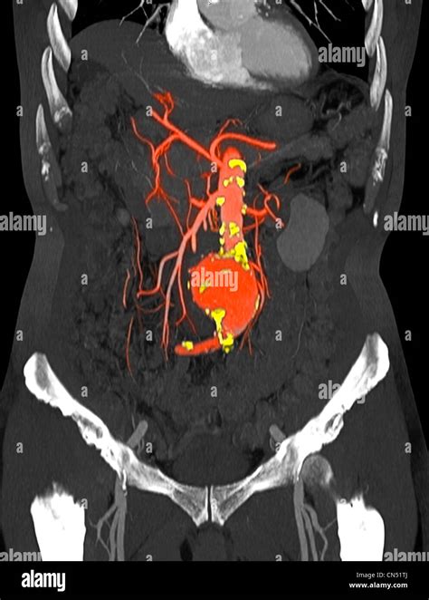 Ct Scan Abdomen Y Pelvis Fotos E Im Genes De Stock Alamy