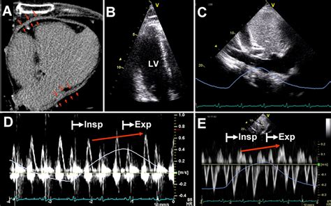 Role Of Echocardiography In The Diagnosis Of Constrictive Pericarditis