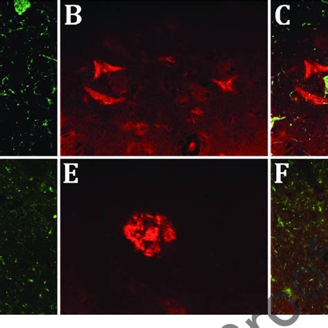 Double Immunofluorescent Staining With AT8 Anti Tau Green A And D