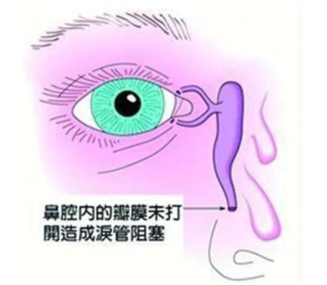 3个月宝宝成天眼泪汪汪？新生儿泪囊炎光靠眼药水可治不了！凤凰网健康凤凰网