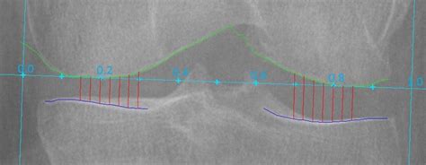 Variance Of Joint Space Width Across The Tibiofemoral Joint On Knee