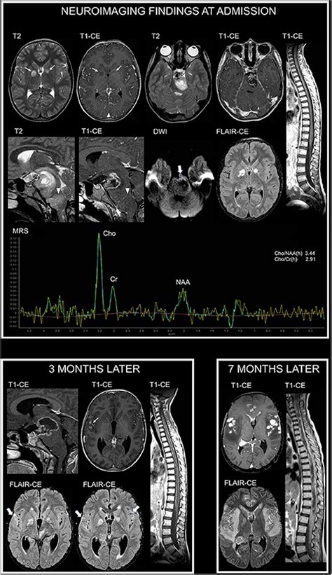 Frontiers Pediatric Diffuse Midline Gliomas H3 K27m Mutant And Non