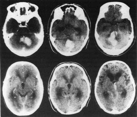 Primary Cerebellar Hemorrhage In Journal Of Neurosurgery Volume 67