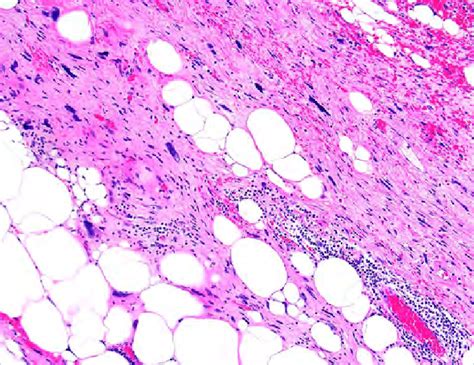 Well Differentiated Liposarcoma The Tumour Is Composed Of Atypical