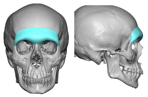 Custom Forehead Implants Eppley Custom Facial Implants