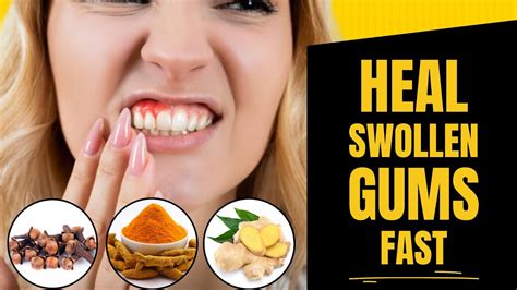 How To Heal Swollen Gums Naturally 100 Fast Result Youtube