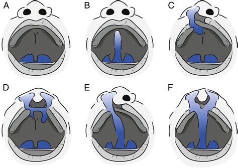 Cleft Lip and Cleft Palate: Symptoms, Causes, Surgery, and Recovery