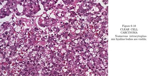 Pathology Outlines Clear Cell Carcinoma