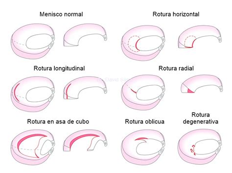 Traumatólogo Especialista En Rotura De Menisco En Madrid