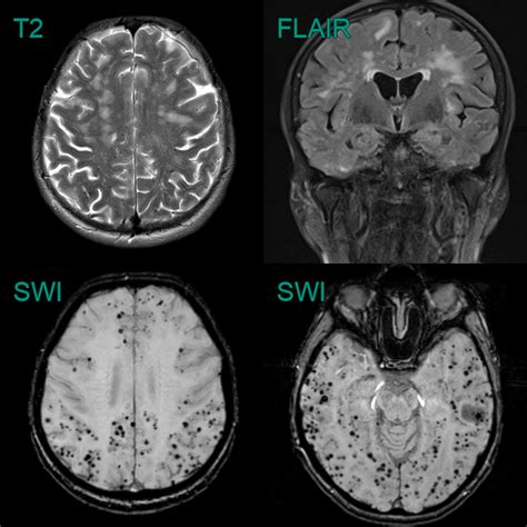 Cerebral Amyloid Angiopathy (CAA) - NEURORADIOLOGY