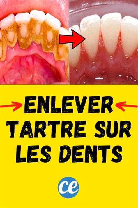 Mes 6 Astuces Pour Enlever le Tartre Dentaire Soi Même