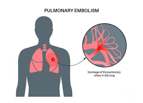 Pulmonary Embolism Photograph By Pikovit Science Photo Library Fine Art America