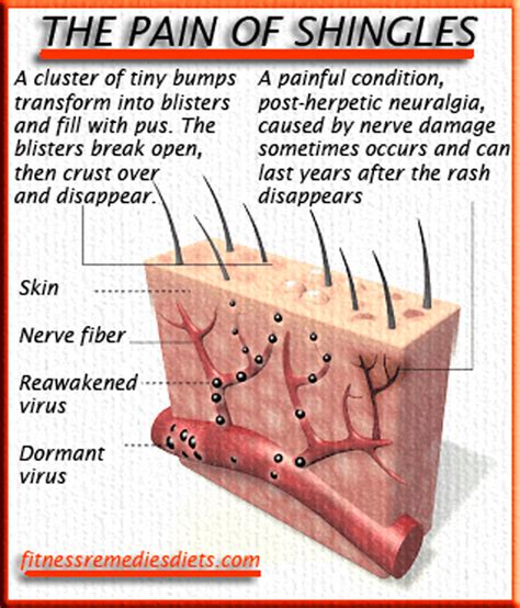 What Is Shingles? And What You Need to Know About Shingles (Herpes ...