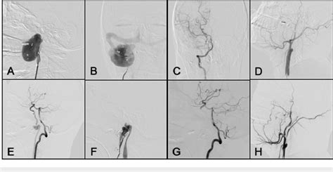 Lateral And Anterior Posterior Projection Of Dsa A B Right Ica With