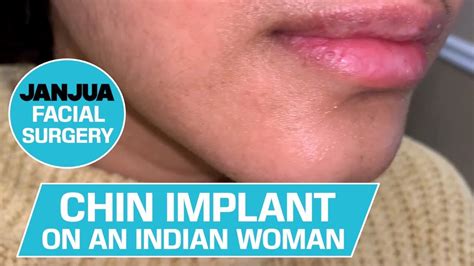 Chin Implant On An Indian Woman Dr Tanveer Janjua New Jersey Youtube