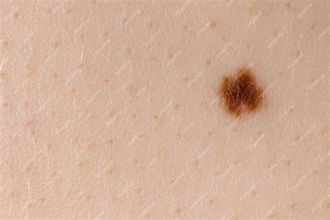 Premium Photo Mole Birthmark Nevus Macro Photo On Human Skin