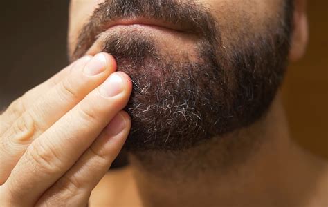 How To Heal Dry Flaky Skin Under Beard Beard Style