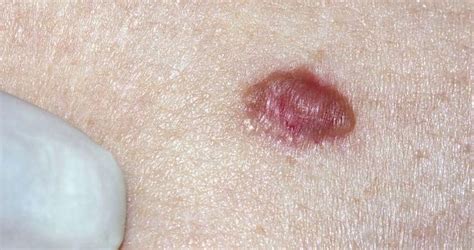 The Hidden Danger of Foot Melanoma | Foot HealthCare Associates