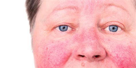 Rosacea | Q Dermatology