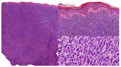 Dermatopathology Free Full Text A Rare Case Of Blastic Plasmacytoid