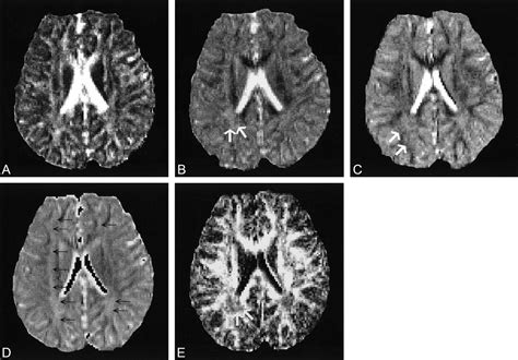 Phenylketonuria Brain