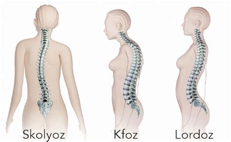 Kifoz Skolyoz Belirtileri Ve Tedavisi