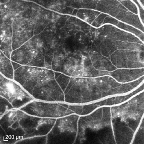 Diabetic Macular Edema Fluorescein Angiography