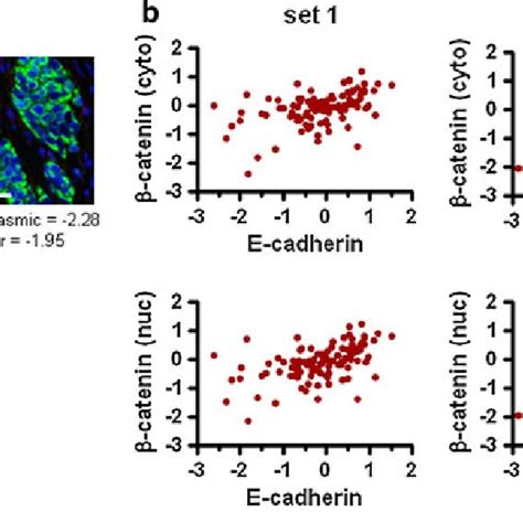 Human Breast Cancer Has A Wide Range Of E Cadherin Protein Expression