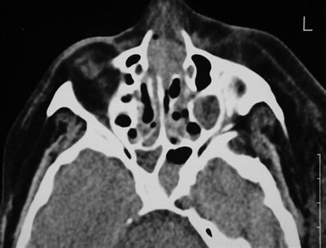 Imaging Features Of Invasive And Noninvasive Fungal Sinusitis A Review Radiographics