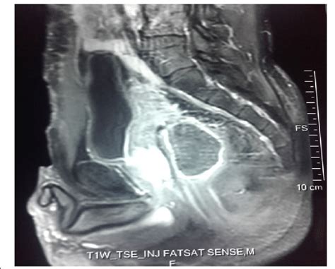 Image Showing Sagittal View Of A T2 Weighted Magnetic Resonance Image