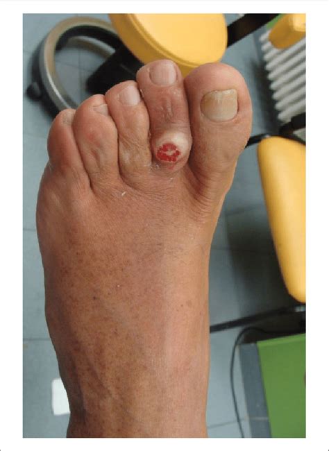 Rigid Hammer Toe With An Ulcer Over The Dorsum Of The Toe Download Scientific Diagram