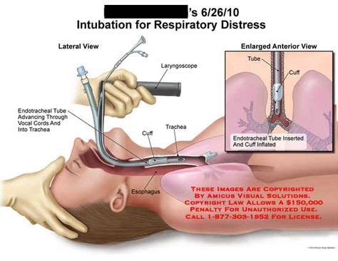 Intubation