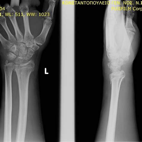 Scaphoid Fracture Classification According To Herbert And Fischer