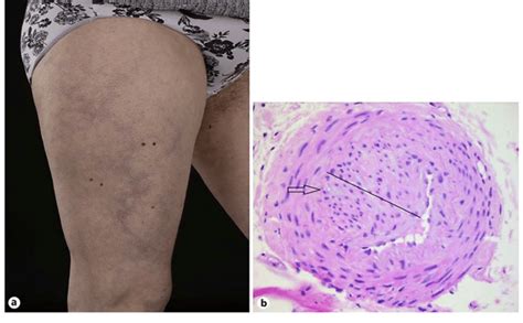 Macroscopic And Microscopic Appearances Of Lr Lr Rash A Present On