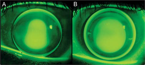 Contact Lens Management Of Keratoconus Downie 2015 Clinical And