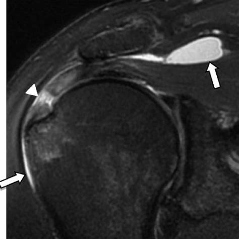 Subacromial Bursitis MRI