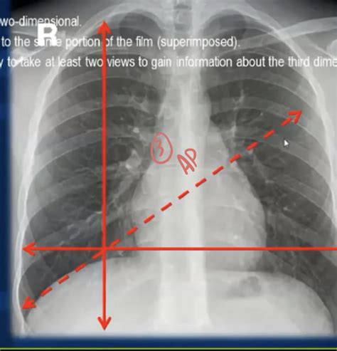 Chest X Rays Flashcards Quizlet