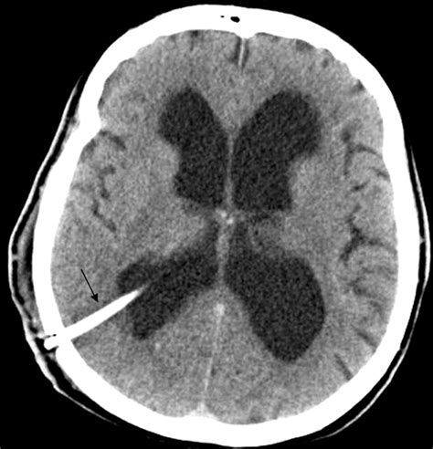 Ventricles Of The Brain Mri