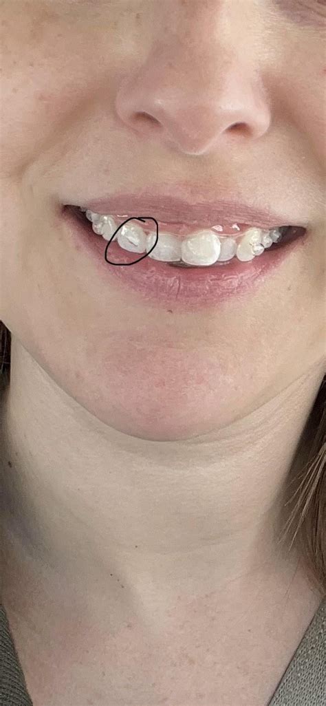 So much pain in one tooth : r/Invisalign
