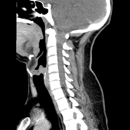 Cervical Schwannoma Image Radiopaedia Org