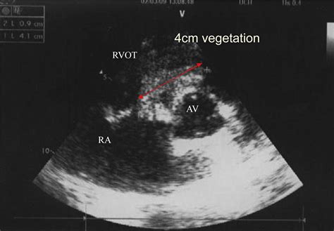 Daptomycin As Successful Treatment For A Refractory Case Of Prosthetic