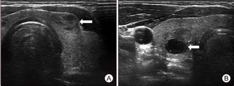 Ultrasound finding. (A) 1 cm sized spongiform nodule in the left ...