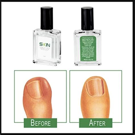 Skinapeel Toe Nail Softener And Ingrown Toenail Treatment Oil Hard Nails On Onbuy