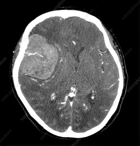 Ct Large Pterional Meningioma Stock Image C Science Photo