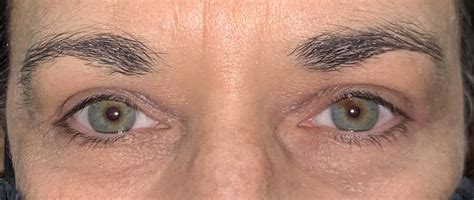 15 Upper Eyelid Surgery Before And After Photos Dallas Plano Texas Cosmetic Reconstructive