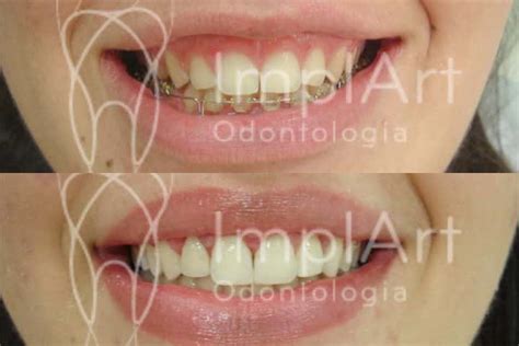 gengivectomia antes e depois 50kb Implante Dentário e Prótese