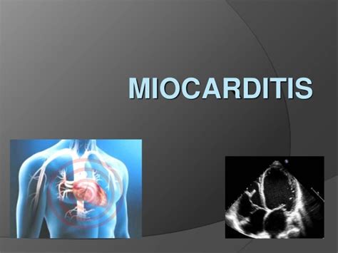 Miocarditis